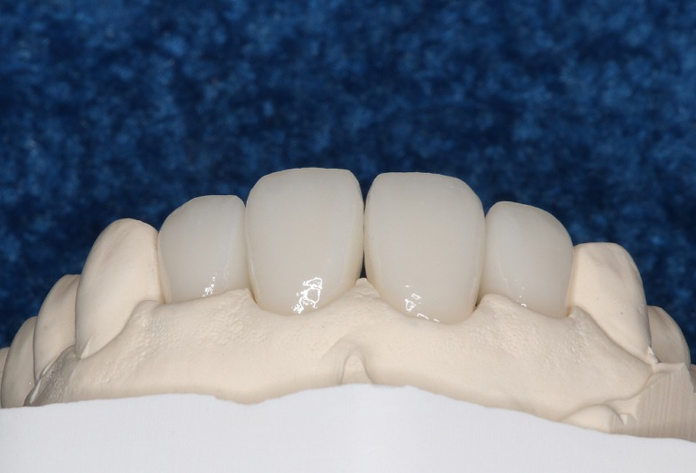 ④オールセラミック装着