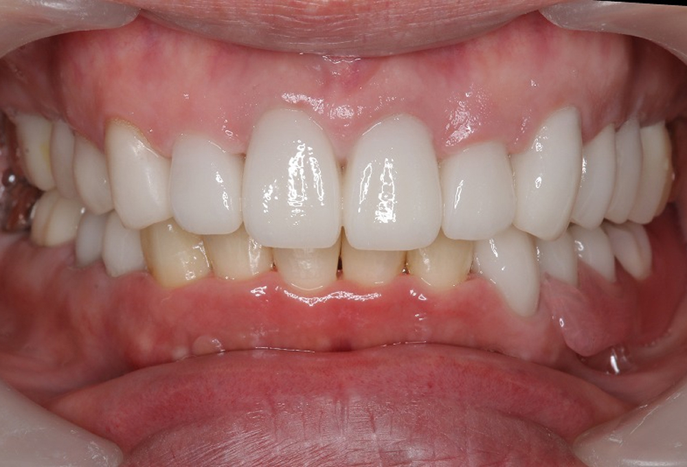 ⑤術後　咬合挙上後オールセラミック装着