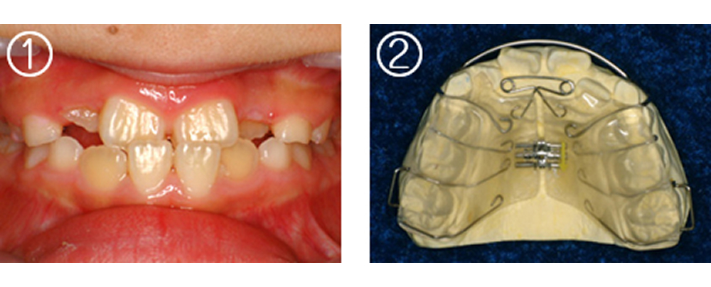 小児の矯正治療（症例）1