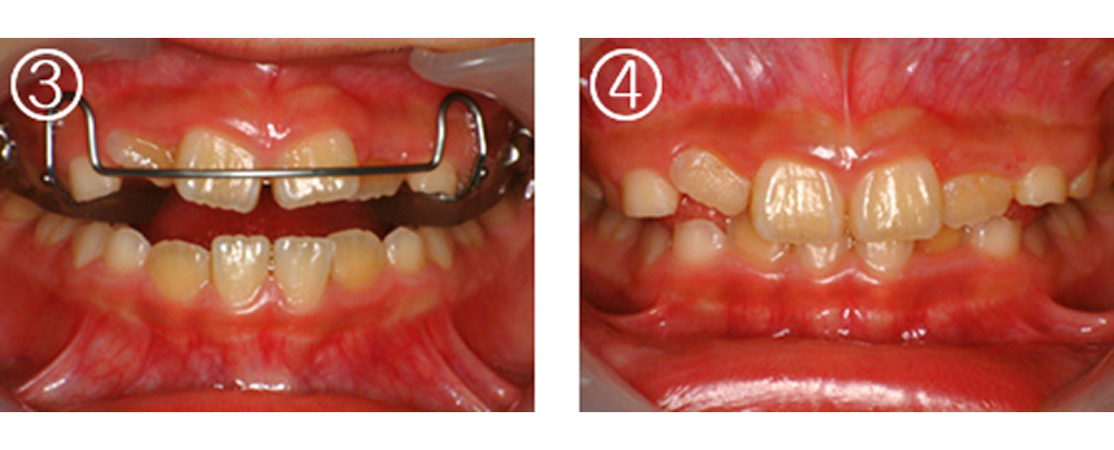小児の矯正治療（症例）1