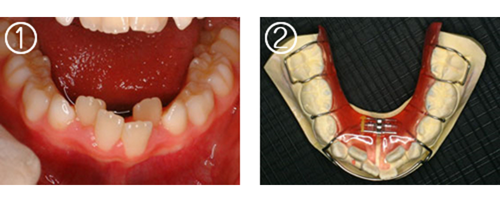 小児の矯正治療（症例）2