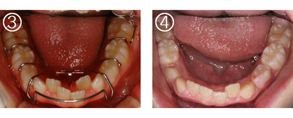 小児の矯正治療（症例）2