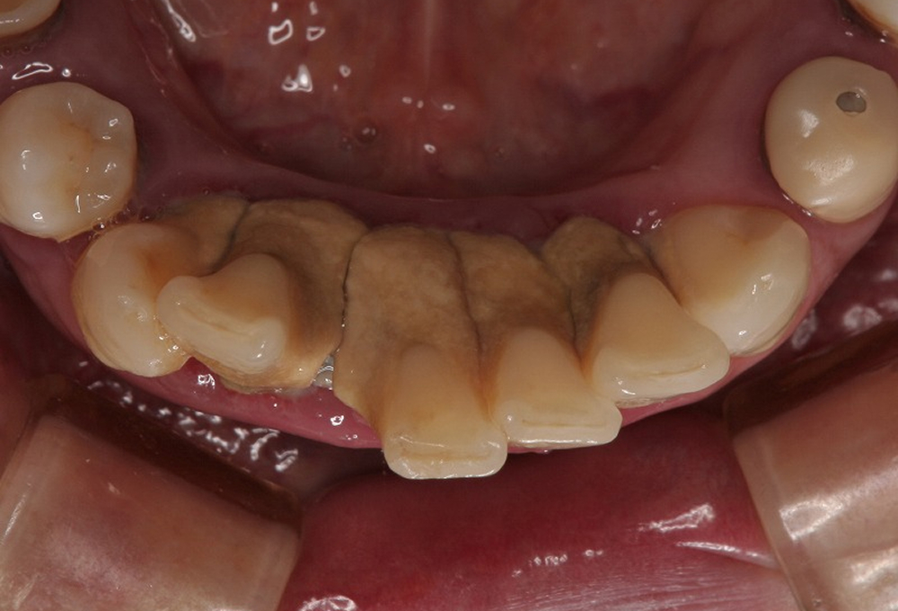 ④大量の歯石
                    