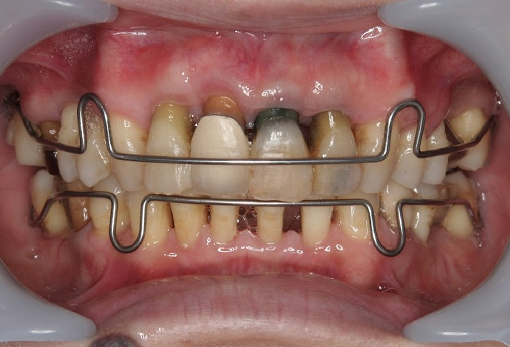 ⑦矯正終了後保定
                    