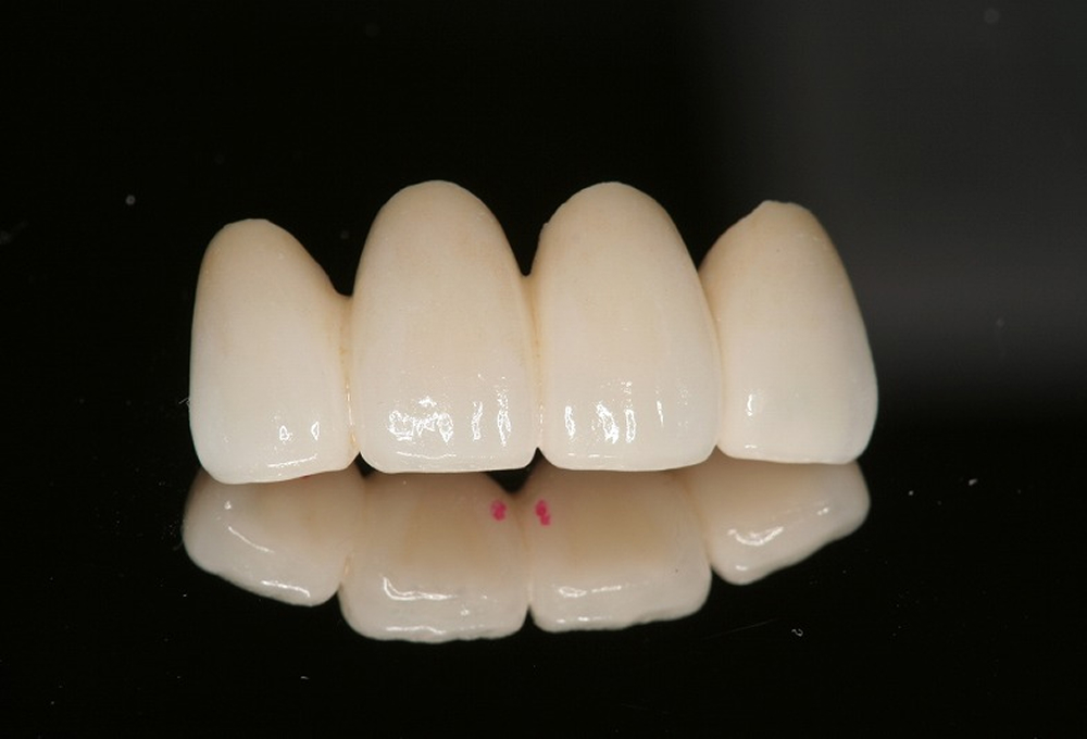 ⑧オールセラミック作成