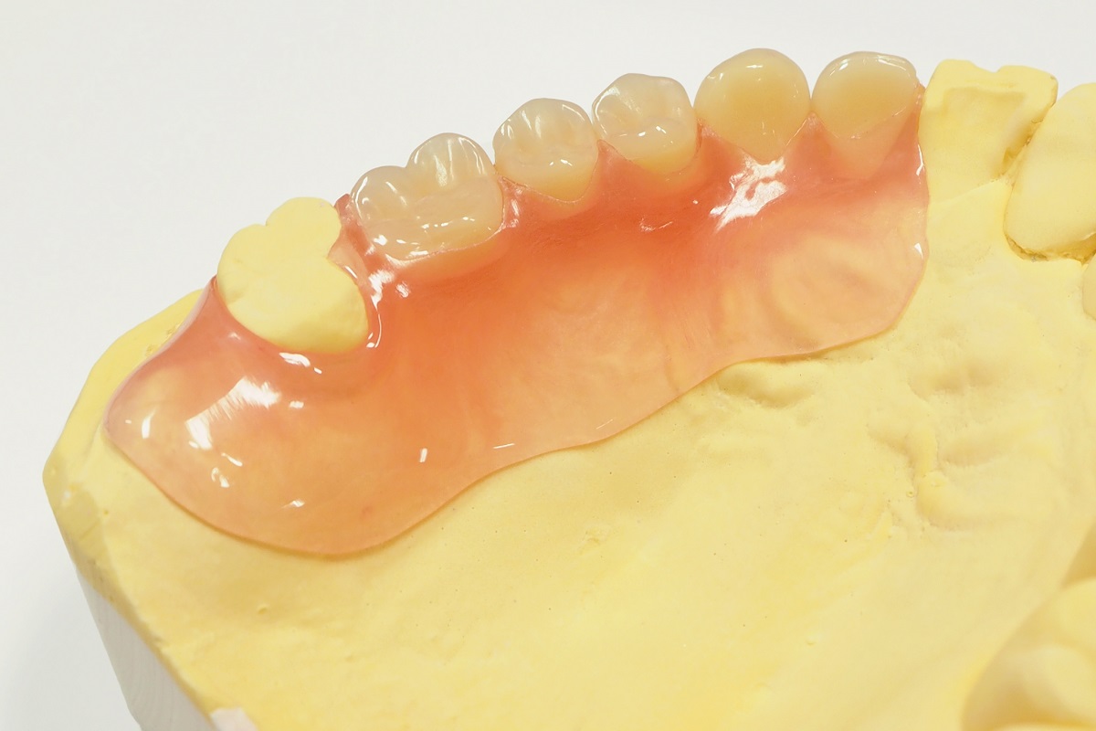 ノンクラスプデンチャー