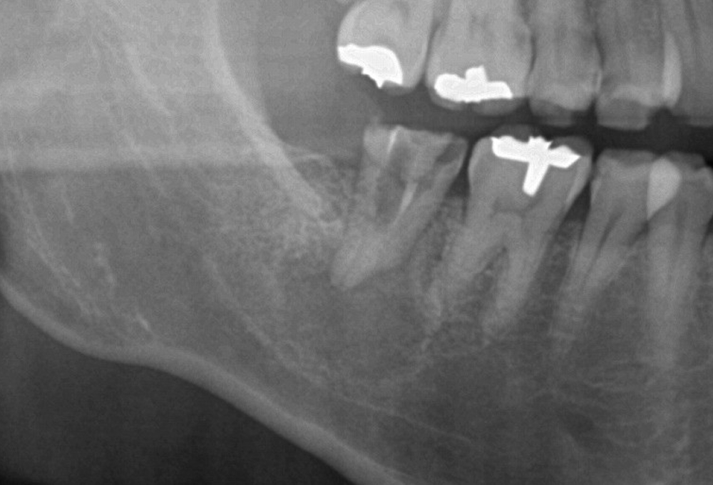 ①術前　歯冠大の根尖病変