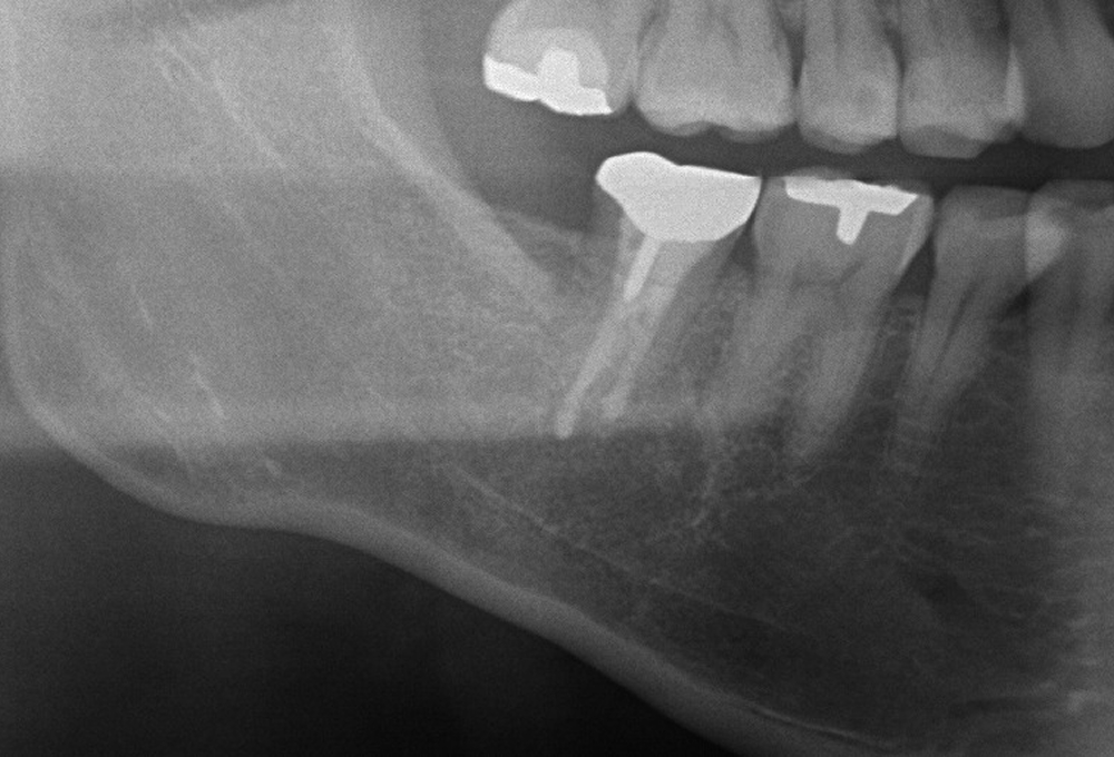 ②術後　感染根管処置後MTAにて根管充填　病変も縮小した