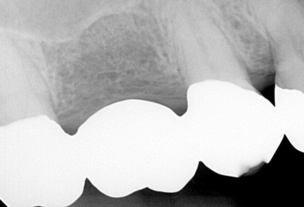 ①左上7感染根管