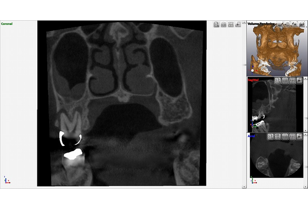 ②CTで上顎洞粘膜肥厚　根尖病変確認