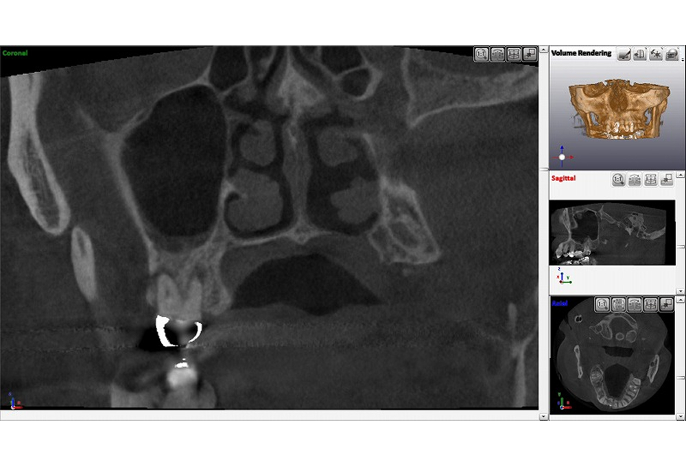 ③処置後のCT 上顎洞粘膜の肥厚も消失