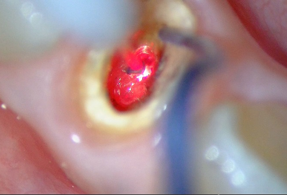 ④YAGレーザーで根管内照射、殺菌