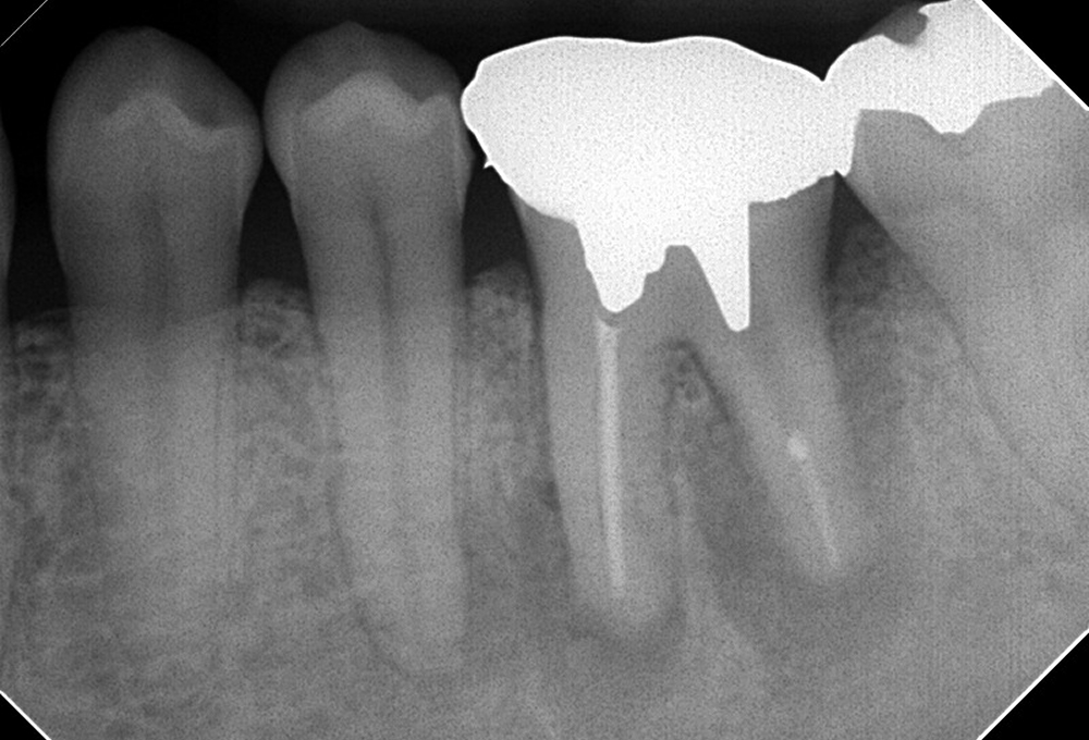 ①術前　下顎大臼歯小豆大の根尖病変