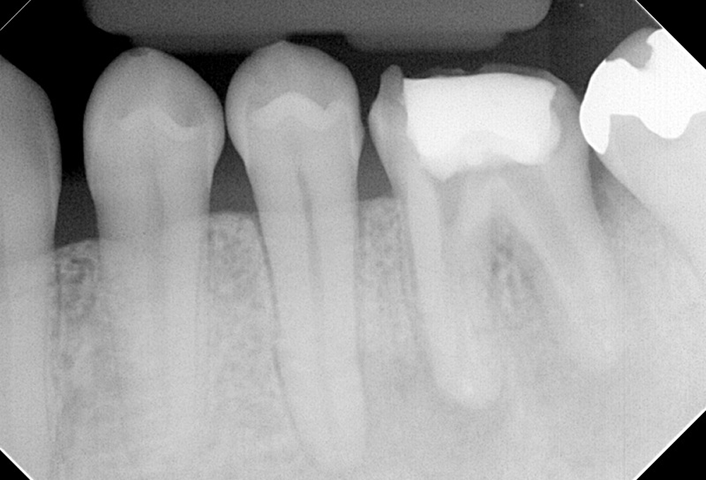 ②感染根管治療途中