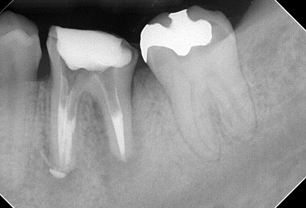③臨床症状もなくなり根管充填