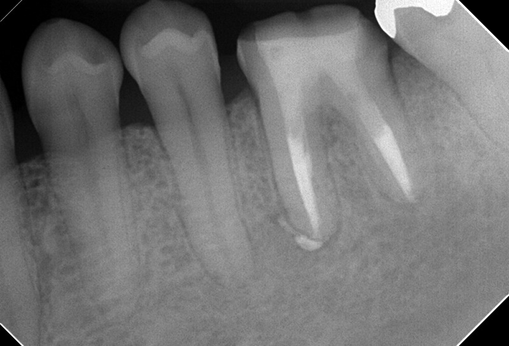④根管充填2カ月後　根尖病変縮小した
