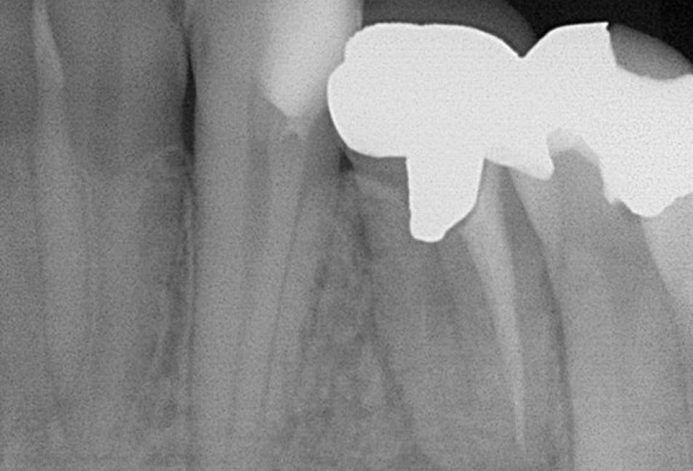 ①術前　下顎小臼歯の根尖病変　未処置根管有