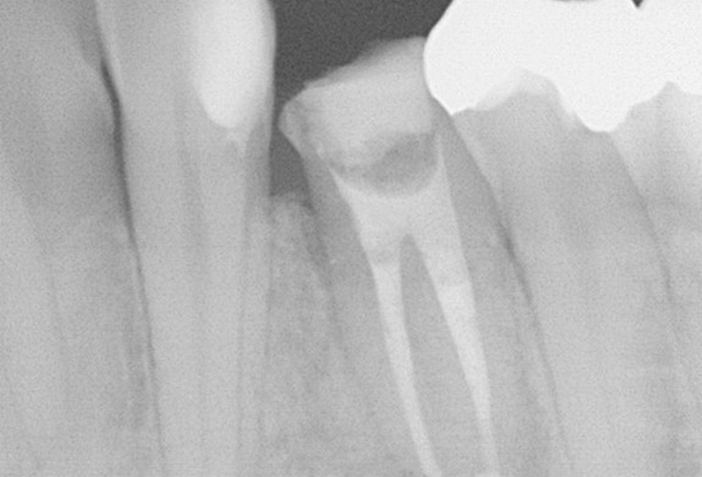 ②根管充填後　未処置根管も治療　根尖病変も縮小した