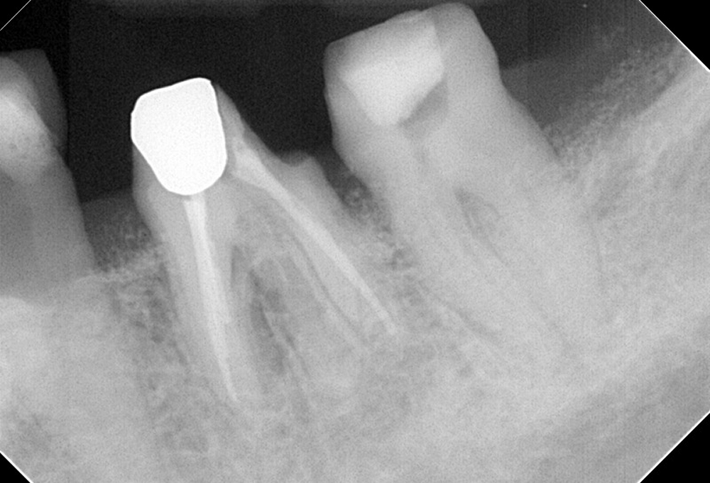 ③破折ファイル除去後